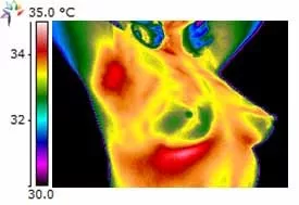 thermography_breast